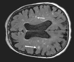 vaskulárna demencia