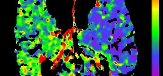 prekrvenie mozgu zobrazené na CT